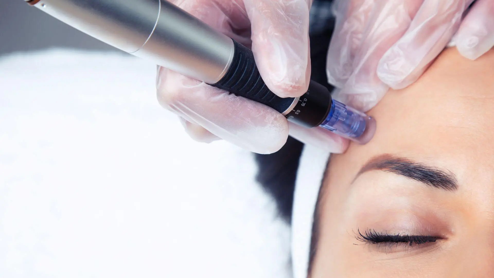 Microneedling Behandlung
